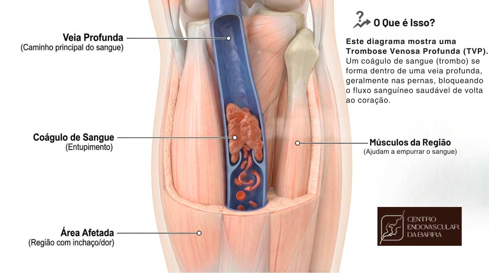 Diagrama médico mostrando trombose venosa profunda (TVP) com coágulo de sangue em uma veia profunda da perna, bloqueando o fluxo sanguíneo.